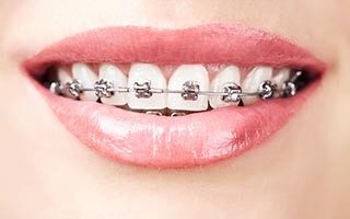 Dental Braces