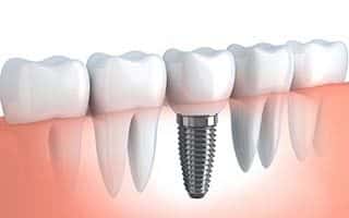 Dental Implant Representation/Rendering
