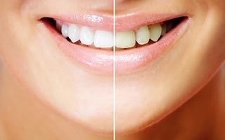 Tooth Whitening Before & After
